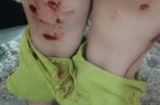 زخمی شدن کودک گلستانی بر اثر حمله سگ بی‌صاحب امنیت کوچه‌ها را چه کسی تضمین می‌کند؟