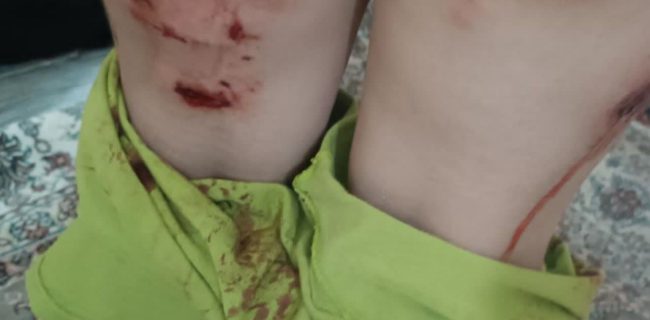 زخمی شدن کودک گلستانی بر اثر حمله سگ بی‌صاحب امنیت کوچه‌ها را چه کسی تضمین می‌کند؟